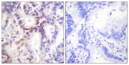 CDKN2B / p15 INK4b Antibody - Immunohistochemistry analysis of paraffin-embedded human lung carcinoma tissue, using p15 INK Antibody. The picture on the right is blocked with the synthesized peptide.