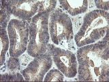 CDKN2B / p15 INK4b Antibody - IHC of paraffin-embedded Adenocarcinoma of Human endometrium tissue using anti-CDKN2B mouse monoclonal antibody.