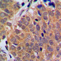 CDKN2C / p18 INK4c Antibody - Immunohistochemical analysis of p18 INK4c staining in human breast cancer formalin fixed paraffin embedded tissue section. The section was pre-treated using heat mediated antigen retrieval with sodium citrate buffer (pH 6.0). The section was then incubated with the antibody at room temperature and detected using an HRP conjugated compact polymer system. DAB was used as the chromogen. The section was then counterstained with hematoxylin and mounted with DPX.