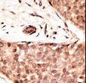 CDX2 Antibody - Formalin-fixed and paraffin-embedded human cancer tissue reacted with the primary antibody, which was peroxidase-conjugated to the secondary antibody, followed by AEC staining. This data demonstrates the use of this antibody for immunohistochemistry; clinical relevance has not been evaluated. BC = breast carcinoma; HC = hepatocarcinoma.