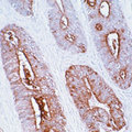 CEA / Carcinoembryonic Antigen Antibody - Formalin-fixed, paraffin-embedded human colon carcinoma stained with peroxidase-conjugate and DAB chromogen. Note cytoplasmic and luminal surface staining of tumor cells.  This image was taken for the unmodified form of this product. Other forms have not been tested.
