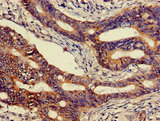 CEACAM7 Antibody - Immunohistochemistry of paraffin-embedded human gastric cancer using CEACAM7 Antibody at dilution of 1:100