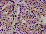 CEAL2 / CEACAM16 Antibody - Immunohistochemistry image at a dilution of 1:500 and staining in paraffin-embedded human liver cancer performed on a Leica BondTM system. After dewaxing and hydration, antigen retrieval was mediated by high pressure in a citrate buffer (pH 6.0) . Section was blocked with 10% normal goat serum 30min at RT. Then primary antibody (1% BSA) was incubated at 4 °C overnight. The primary is detected by a biotinylated secondary antibody and visualized using an HRP conjugated SP system.