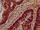 CEB1 / HERC5 Antibody - Immunohistochemistry Dilution at 1:100 and staining in paraffin-embedded human ovarian cancer performed on a Leica BondTM system. After dewaxing and hydration, antigen retrieval was mediated by high pressure in a citrate buffer (pH 6.0). Section was blocked with 10% normal Goat serum 30min at RT. Then primary antibody (1% BSA) was incubated at 4°C overnight. The primary is detected by a biotinylated Secondary antibody and visualized using an HRP conjugated SP system.