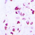 CEBPD + CEBPE Antibody - Immunohistochemical analysis of C/EBP delta/epsilon staining in human lung cancer formalin fixed paraffin embedded tissue section. The section was pre-treated using heat mediated antigen retrieval with sodium citrate buffer (pH 6.0). The section was then incubated with the antibody at room temperature and detected using an HRP conjugated compact polymer system. DAB was used as the chromogen. The section was then counterstained with hematoxylin and mounted with DPX.