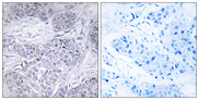 CEBPG / CEBP Gamma Antibody - Immunohistochemistry analysis of paraffin-embedded human breast carcinoma tissue, using CEBPG Antibody. The picture on the right is blocked with the synthesized peptide.