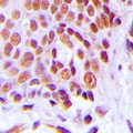 CEBPG / CEBP Gamma Antibody - Immunohistochemical analysis of C/EBP gamma staining in human breast cancer formalin fixed paraffin embedded tissue section. The section was pre-treated using heat mediated antigen retrieval with sodium citrate buffer (pH 6.0). The section was then incubated with the antibody at room temperature and detected with HRP and DAB as chromogen. The section was then counterstained with hematoxylin and mounted with DPX.