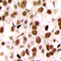 CEBPZ / CBF Antibody - Immunohistochemical analysis of C/EBP zeta staining in human breast cancer formalin fixed paraffin embedded tissue section. The section was pre-treated using heat mediated antigen retrieval with sodium citrate buffer (pH 6.0). The section was then incubated with the antibody at room temperature and detected with HRP and DAB as chromogen. The section was then counterstained with hematoxylin and mounted with DPX.