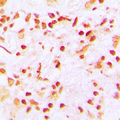 CENPA / CENP-A Antibody - Immunohistochemical analysis of CENPA staining in human lung cancer formalin fixed paraffin embedded tissue section. The section was pre-treated using heat mediated antigen retrieval with sodium citrate buffer (pH 6.0). The section was then incubated with the antibody at room temperature and detected using an HRP conjugated compact polymer system. DAB was used as the chromogen. The section was then counterstained with hematoxylin and mounted with DPX. w
