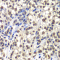 CENPC / CENP-C Antibody - Immunohistochemistry of paraffin-embedded human kidney cancer tissue.
