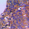 CEP41 / TSGA14 Antibody - Immunohistochemical analysis of CEP41 staining in human breast cancer formalin fixed paraffin embedded tissue section. The section was pre-treated using heat mediated antigen retrieval with sodium citrate buffer (pH 6.0). The section was then incubated with the antibody at room temperature and detected using an HRP conjugated compact polymer system. DAB was used as the chromogen. The section was then counterstained with hematoxylin and mounted with DPX.
