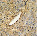 CEP63 Antibody - CEP63 Antibody IHC of formalin-fixed and paraffin-embedded prostate carcinoma followed by peroxidase-conjugated secondary antibody and DAB staining.