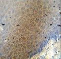 CEP70 Antibody - CEP70 antibody immunohistochemistry of formalin-fixed and paraffin-embedded human skin carcinoma followed by peroxidase-conjugated secondary antibody and DAB staining.