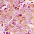CEP76 Antibody - Immunohistochemical analysis of CEP76 staining in human breast cancer formalin fixed paraffin embedded tissue section. The section was pre-treated using heat mediated antigen retrieval with sodium citrate buffer (pH 6.0). The section was then incubated with the antibody at room temperature and detected with HRP and DAB as chromogen. The section was then counterstained with hematoxylin and mounted with DPX.