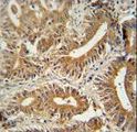 CEP89 Antibody - CCDC123 antibody immunohistochemistry of formalin-fixed and paraffin-embedded human colon carcinoma followed by peroxidase-conjugated secondary antibody and DAB staining.