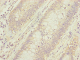 CEP95 / CCDC45 Antibody - Immunohistochemistry of paraffin-embedded human colon cancer at dilution of 1:100