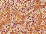 Ceramide Kinase / CERK Antibody - Immunohistochemistry of paraffin-embedded human pancreatic cancer using CERK Antibody at dilution of 1:100