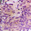 CERKL Antibody - Immunohistochemical analysis of CERKL staining in human prostate cancer formalin fixed paraffin embedded tissue section. The section was pre-treated using heat mediated antigen retrieval with sodium citrate buffer (pH 6.0). The section was then incubated with the antibody at room temperature and detected using an HRP conjugated compact polymer system. DAB was used as the chromogen. The section was then counterstained with hematoxylin and mounted with DPX. w