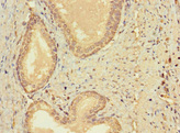 CERKL Antibody - Paraffin-embedding Immunohistochemistry using human prostate cancer at dilution 1:100