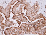 CES2 / Esterase Antibody - IHC of paraffin-embedded Colon ca, using CES2 antibody at 1:500 dilution.
