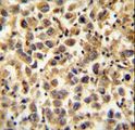 CFAP45 / CCDC19 Antibody - CCDC19 Antibody immunohistochemistry of formalin-fixed and paraffin-embedded human testis carcinoma followed by peroxidase-conjugated secondary antibody and DAB staining.