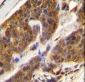 CFD / Factor D / Adipsin Antibody - CFD Antibody immunohistochemistry of formalin-fixed and paraffin-embedded human bladder carcinoma followed by peroxidase-conjugated secondary antibody and DAB staining.
