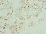CFDP1 Antibody - Immunohistochemistry of paraffin-embedded human bladder cancer at dilution 1:100