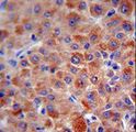 CFH / Complement Factor H Antibody - CFH antibody immunohistochemistry of formalin-fixed and paraffin-embedded human hepatocarcinoma followed by peroxidase-conjugated secondary antibody and DAB staining.