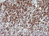CHAF1B / CAF1 Antibody - IHC of paraffin-embedded Human lymphoma tissue using anti-CHAF1B mouse monoclonal antibody. (Heat-induced epitope retrieval by 10mM citric buffer, pH6.0, 120°C for 3min).