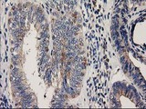 CHCHD5 Antibody - IHC of paraffin-embedded Adenocarcinoma of Human endometrium tissue using anti-CHCHD5 mouse monoclonal antibody.