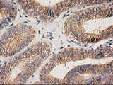 CHCHD5 Antibody - IHC of paraffin-embedded Adenocarcinoma of Human endometrium tissue using anti-CHCHD5 mouse monoclonal antibody. (Heat-induced epitope retrieval by 10mM citric buffer, pH6.0, 100C for 10min).
