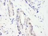 CHD3 Antibody - Detection of Human CHD3 by Immunohistochemistry. Sample: FFPE section of human prostate carcinoma. Antibody: Affinity purified rabbit anti-CHD3 used at a dilution of 1:1000 (1 ug/ml).