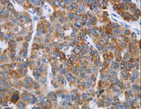 CHDH / CHD Antibody - Immunohistochemistry of paraffin-embedded Human liver cancer using CHDH Polyclonal Antibody at dilution of 1:20.