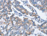 CHDH / CHD Antibody - Immunohistochemistry of paraffin-embedded Human breast cancer using CHDH Polyclonal Antibody at dilution of 1:25.