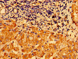 CHDH / CHD Antibody - Immunohistochemistry image of paraffin-embedded human liver cancer at a dilution of 1:100