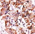 CHEK1 / CHK1 Antibody - Formalin-fixed and paraffin-embedded human cancer tissue reacted with the primary antibody, which was peroxidase-conjugated to the secondary antibody, followed by AEC staining. This data demonstrates the use of this antibody for immunohistochemistry; clinical relevance has not been evaluated. BC = breast carcinoma; HC = hepatocarcinoma.