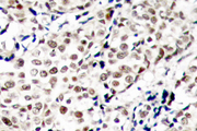 CHEK1 / CHK1 Antibody - IHC of p-Chk1 (S345) pAb in paraffin-embedded human breast carcinoma tissue.