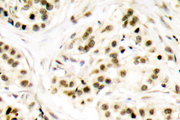 CHEK2 / CHK2 Antibody - IHC of p-Chk2 (T68) pAb in paraffin-embedded human breast carcinoma tissue.