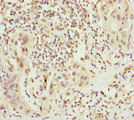 CHIC2 Antibody - Immunohistochemistry of paraffin-embedded human bladder cancer at dilution 1:100