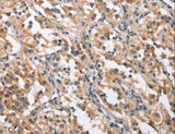 CHMP1A Antibody - Immunohistochemistry of paraffin-embedded Human thyroid cancer using CHMP1A Polyclonal Antibody at dilution of 1:60.