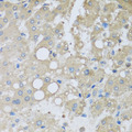 CHMP1B Antibody - Immunohistochemistry of paraffin-embedded human liver injury tissue.