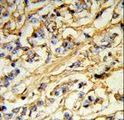 CHMP4B Antibody - Formalin-fixed and paraffin-embedded human breast carcinoma reacted with CHMP4B Antibody , which was peroxidase-conjugated to the secondary antibody, followed by DAB staining. This data demonstrates the use of this antibody for immunohistochemistry; clinical relevance has not been evaluated.
