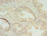 CHMP7 Antibody - Immunohistochemistry of paraffin-embedded human prostate cancer using antibody at dilution of 1:100.