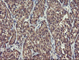 CHN1 Antibody - IHC of paraffin-embedded Carcinoma of Human thyroid tissue using anti-CHN1 mouse monoclonal antibody.
