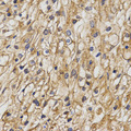 CHRNB1 Antibody - Immunohistochemistry of paraffin-embedded human kidney cancer using CHRNB1 antibody at dilution of 1:200 (x400 lens)