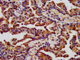 CHRNB3 Antibody - Immunohistochemistry image at a dilution of 1:400 and staining in paraffin-embedded human lung cancer performed on a Leica BondTM system. After dewaxing and hydration, antigen retrieval was mediated by high pressure in a citrate buffer (pH 6.0) . Section was blocked with 10% normal goat serum 30min at RT. Then primary antibody (1% BSA) was incubated at 4 °C overnight. The primary is detected by a biotinylated secondary antibody and visualized using an HRP conjugated SP system.