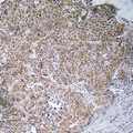 CHST13 Antibody - Immunohistochemical analysis of CHST13 staining in human liver cancer formalin fixed paraffin embedded tissue section. The section was pre-treated using heat mediated antigen retrieval with sodium citrate buffer (pH 6.0). The section was then incubated with the antibody at room temperature and detected with HRP and DAB as chromogen. The section was then counterstained with hematoxylin and mounted with DPX.
