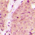 Antibody - Immunohistochemical analysis of IKK alpha/beta staining in human breast cancer formalin fixed paraffin embedded tissue section. The section was pre-treated using heat mediated antigen retrieval with sodium citrate buffer (pH 6.0). The section was then incubated with the antibody at room temperature and detected using an HRP polymer system. DAB was used as the chromogen. The section was then counterstained with hematoxylin and mounted with DPX.