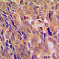 CHUK / IKKA / IKK Alpha Antibody - Immunohistochemical analysis of IKK alpha staining in human breast cancer formalin fixed paraffin embedded tissue section. The section was pre-treated using heat mediated antigen retrieval with sodium citrate buffer (pH 6.0). The section was then incubated with the antibody at room temperature and detected using an HRP conjugated compact polymer system. DAB was used as the chromogen. The section was then counterstained with hematoxylin and mounted with DPX.