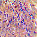 CHUK / IKKA / IKK Alpha Antibody - Immunohistochemical analysis of IKK alpha (pT23) staining in human breast cancer formalin fixed paraffin embedded tissue section. The section was pre-treated using heat mediated antigen retrieval with sodium citrate buffer (pH 6.0). The section was then incubated with the antibody at room temperature and detected using an HRP conjugated compact polymer system. DAB was used as the chromogen. The section was then counterstained with hematoxylin and mounted with DPX.